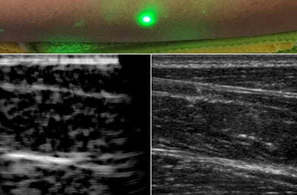 全球首張人類(lèi)激光超聲波圖像問(wèn)世